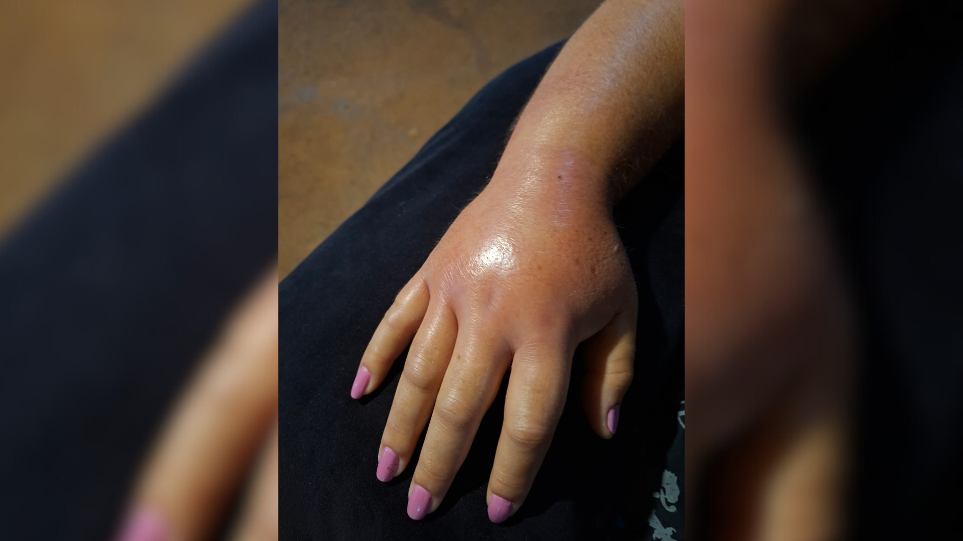 Mulher picada por jararaca ao colher abóboras no interior de SP relata dor insuportável: 'Achei que fosse morrer'