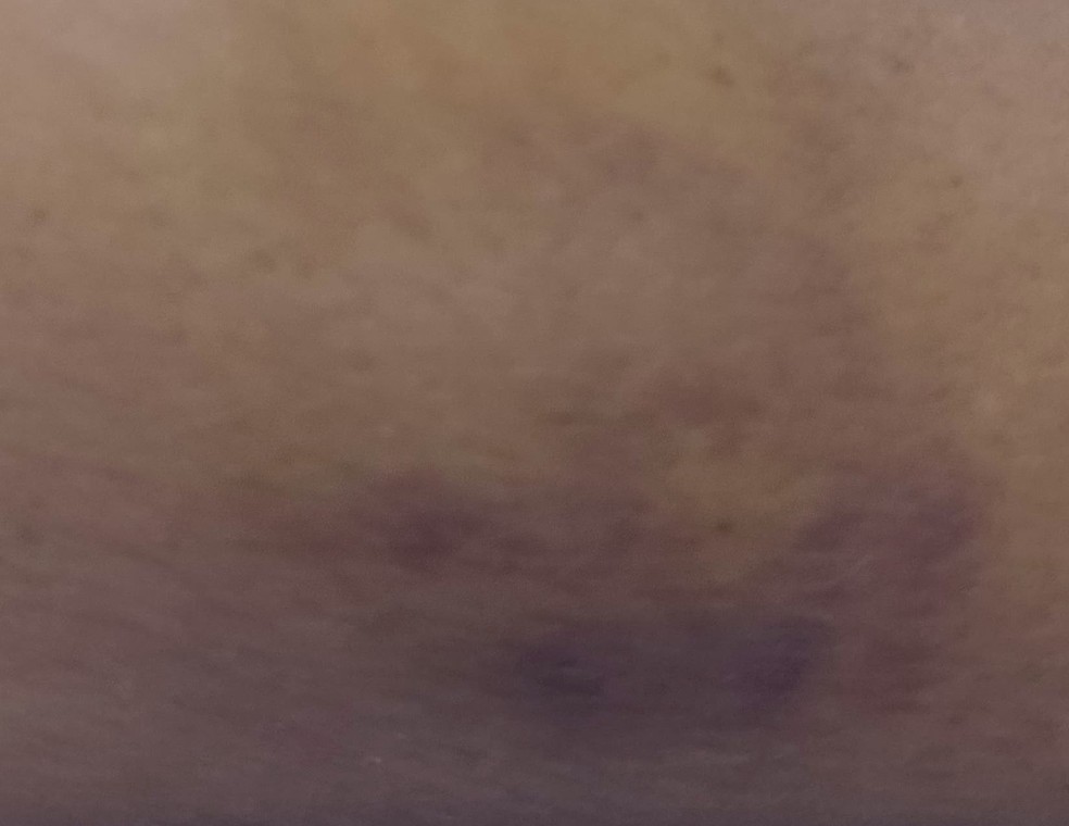 Professora foi mordida no braço por mãe de aluno em uma creche de Camaragibe — Foto: Reprodução/Whatsapp