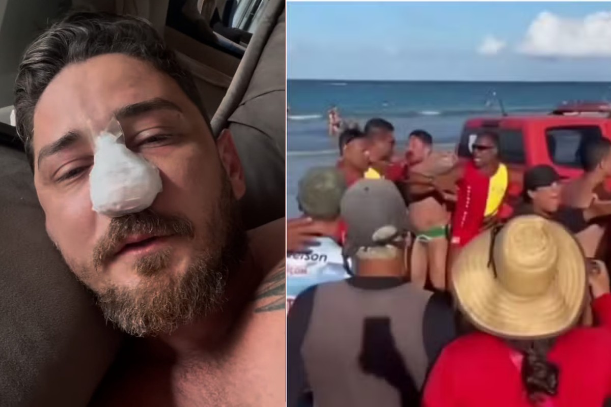 Agredido em Porto de Galinhas passa por cirurgia em MT após identificar 4 fraturas no rosto 