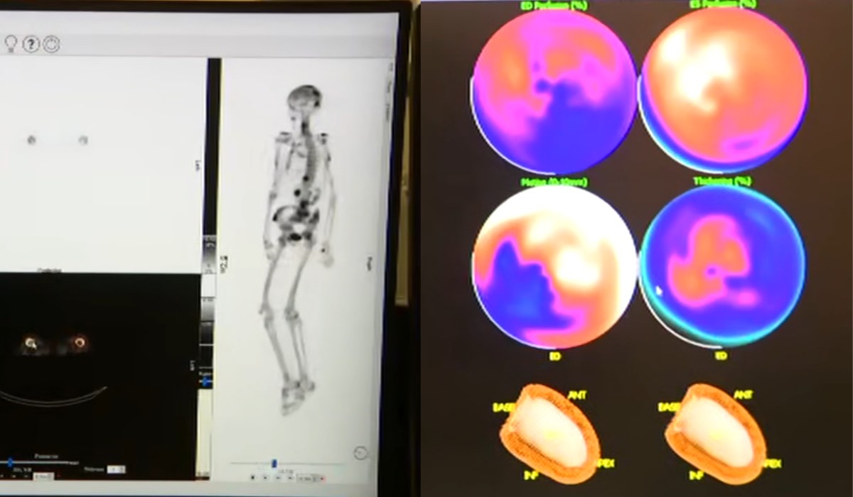 Unicamp recebe 1º equipamento que melhora diagnóstico de câncer no SUS com inteligência artificial e medicina nuclear 