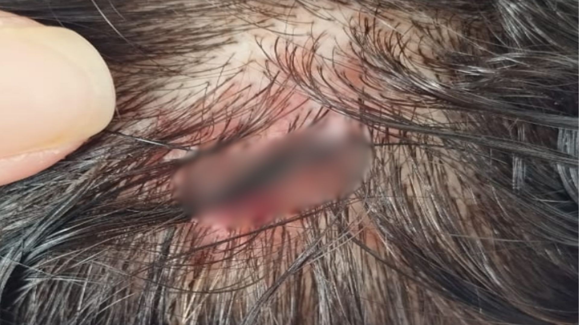 Homem é preso suspeito de morder e arrancar dedo de mulher em Auriflama
