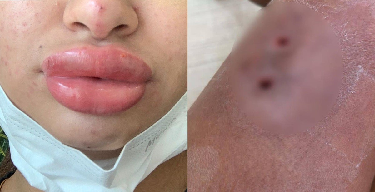 Infecções e deformação: mulheres denunciam falsa biomédica por falhas em procedimentos estéticos em SC