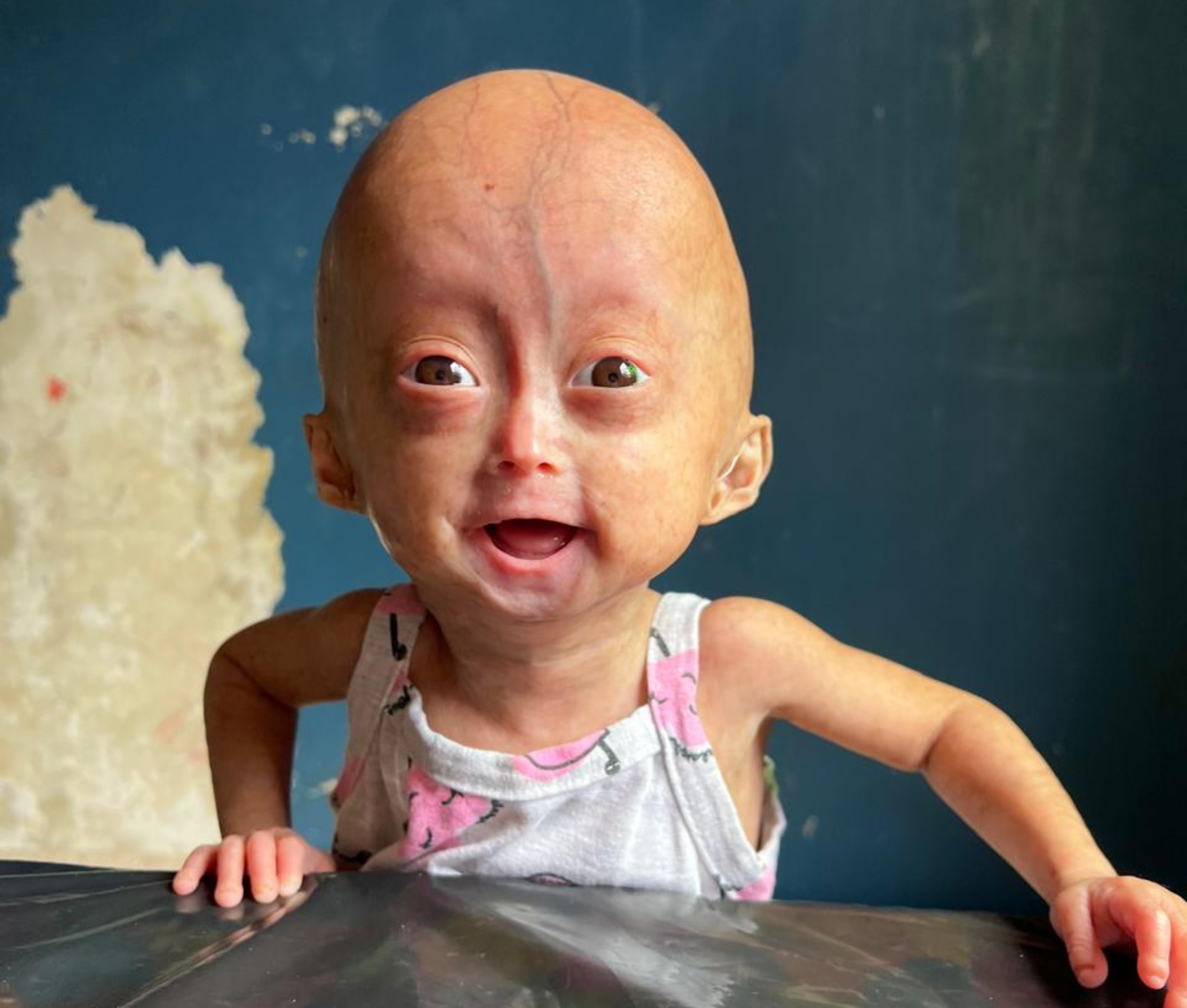 Gêmea que morreu com síndrome rara de velhice precoce fazia sucesso com irmã nas redes e tinha mais de 1 bilhão de visualizações