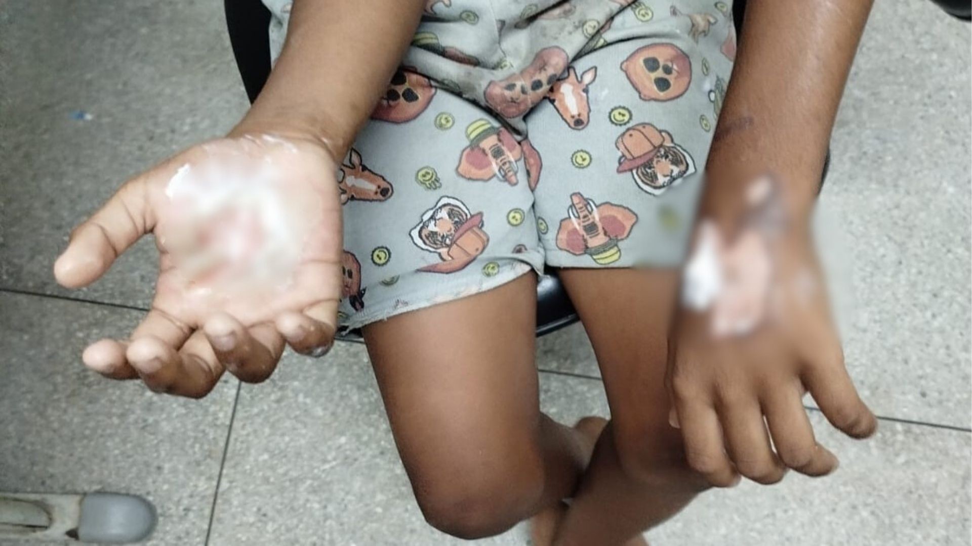 Mãe é presa por tortura após queimar mãos do filho de 10 anos com colher e ovos quentes; irmãos da vítima são apreendidos