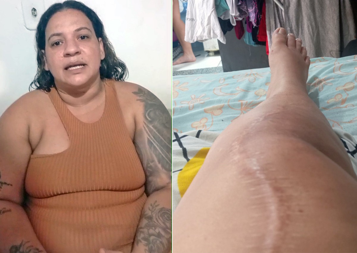 Sem poder andar, cabeleireira aguarda há 1 ano por cirurgia para reparar prótese quebrada