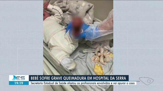 Bebê sofre queimadura no pé em hospital Jayme Santos Neves na Serra no ES