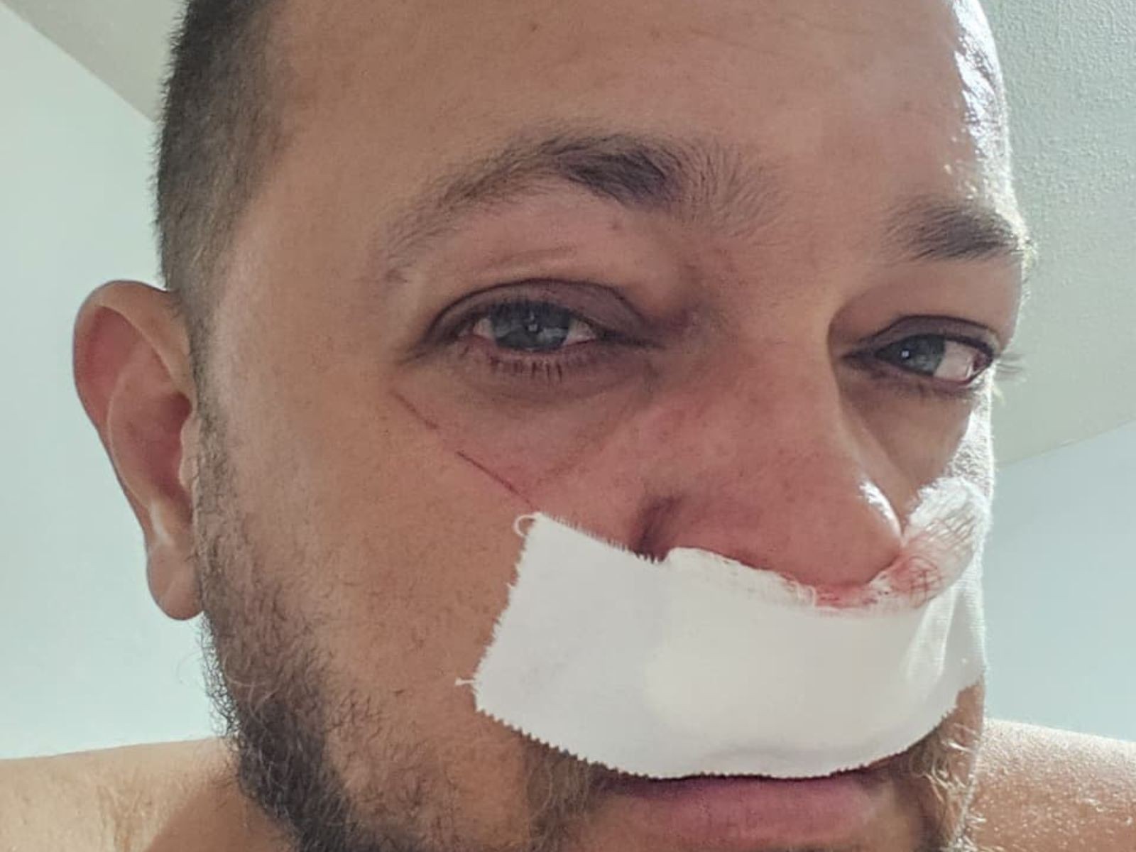 Motociclista sofre corte profundo ao ser atingido por linha de pipa em Rio Branco: 'Rosto cheio de sangue'