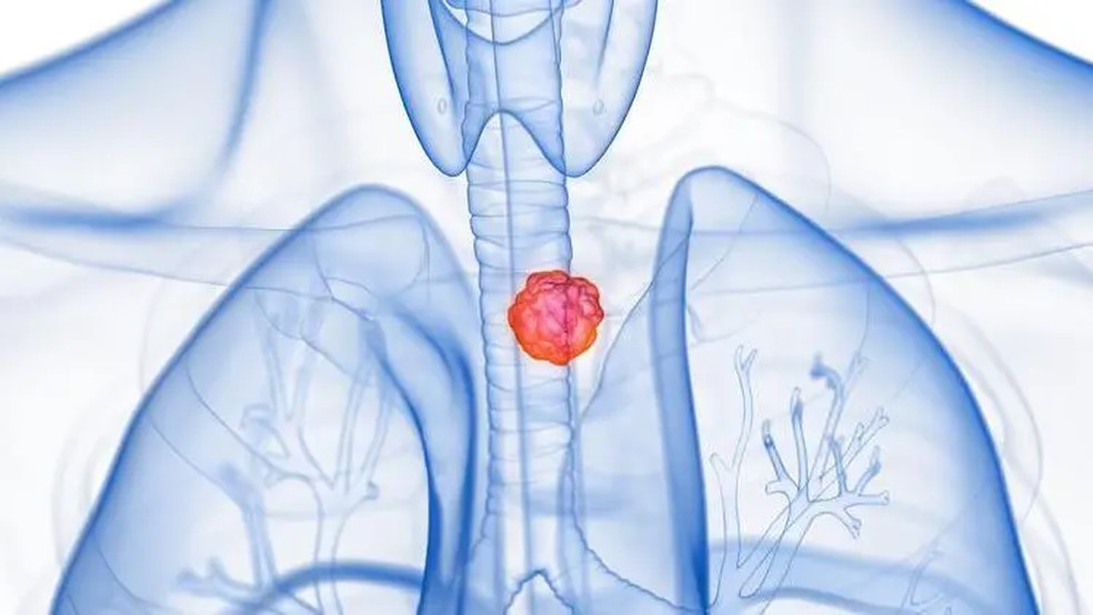 Fazer quimioterapia antes e depois de uma cirurgia amplia sobrevida de pacientes com tumor no esôfago — Foto: GETTY IMAGES via BBC