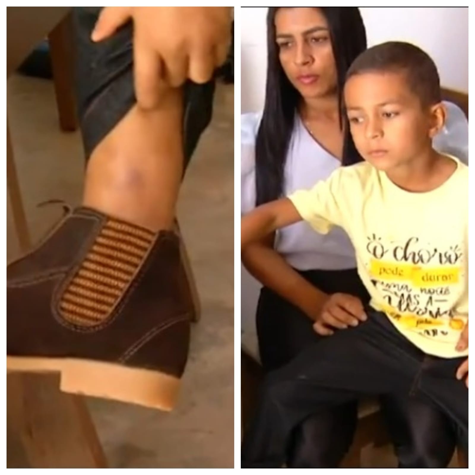 Menino que sobreviveu a picada de jararaca foi surpreendido por cobra: 'Estava fechando o portão'