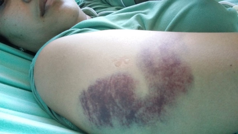 Passageira ficou com hematomas no braço após agressão de motorista de aplicativo em Fortaleza. — Foto: Arquivo pessoal