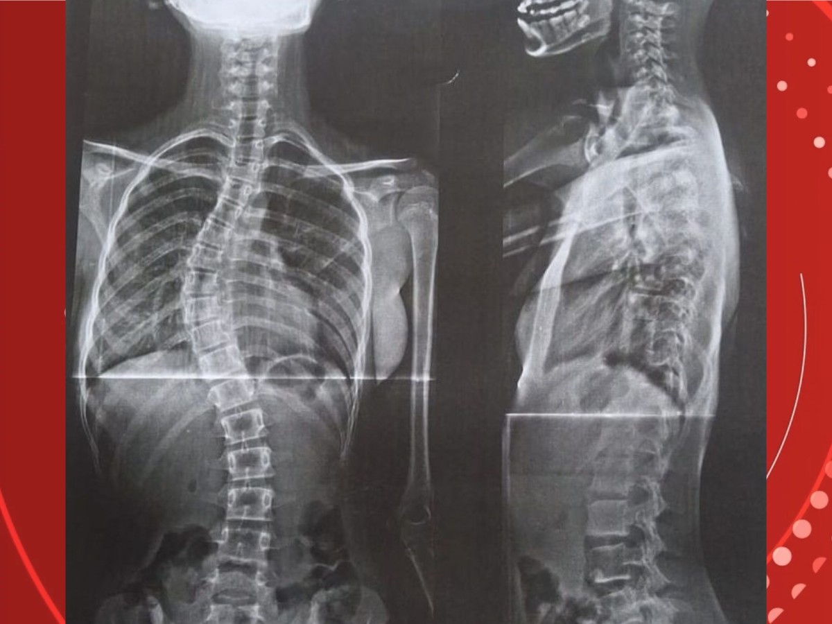 Após enfrentar o governo, mãe consegue cirurgia para filha com coluna em formato de 'S' em RO