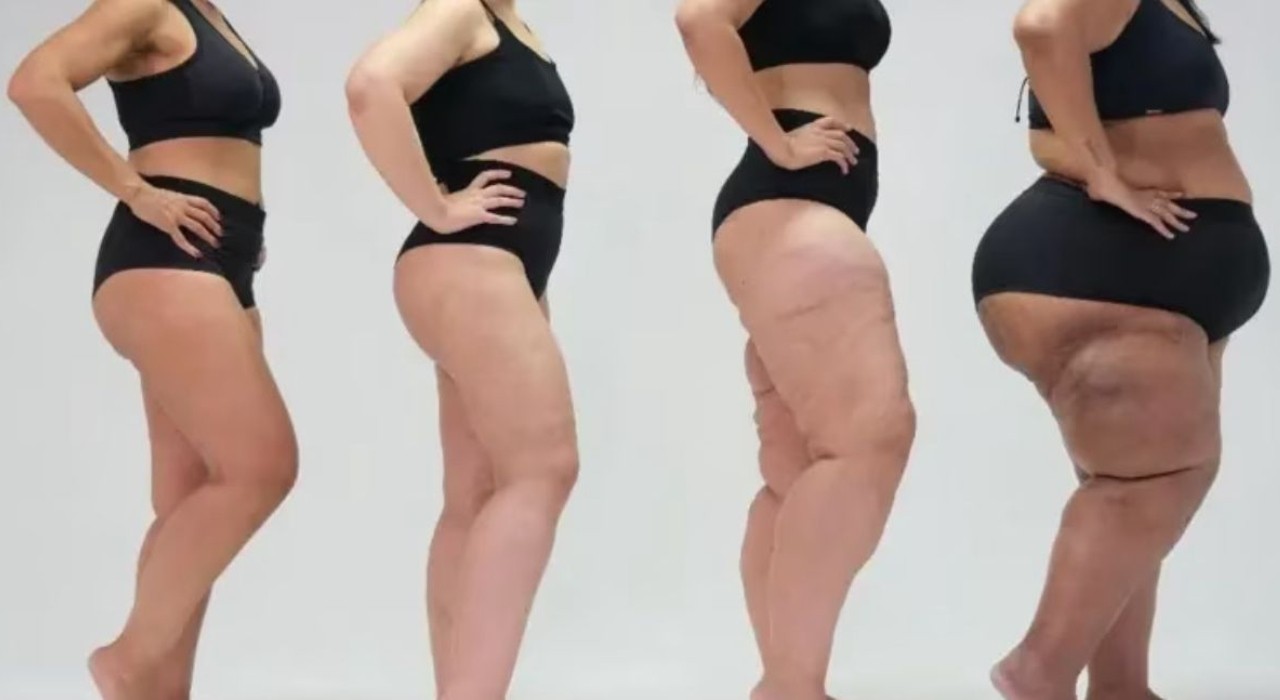 Lipedema: o que é e como tratar a doença confundida com obesidade
