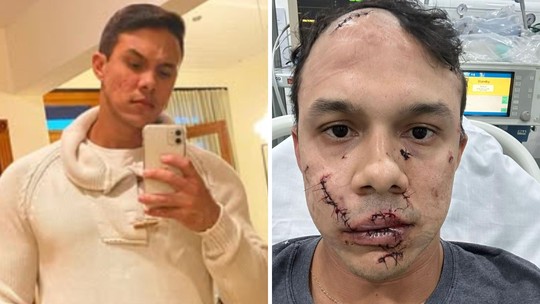 Personal agredido no rosto relata cicatrizes e falta de dinheiro para cirurgião 