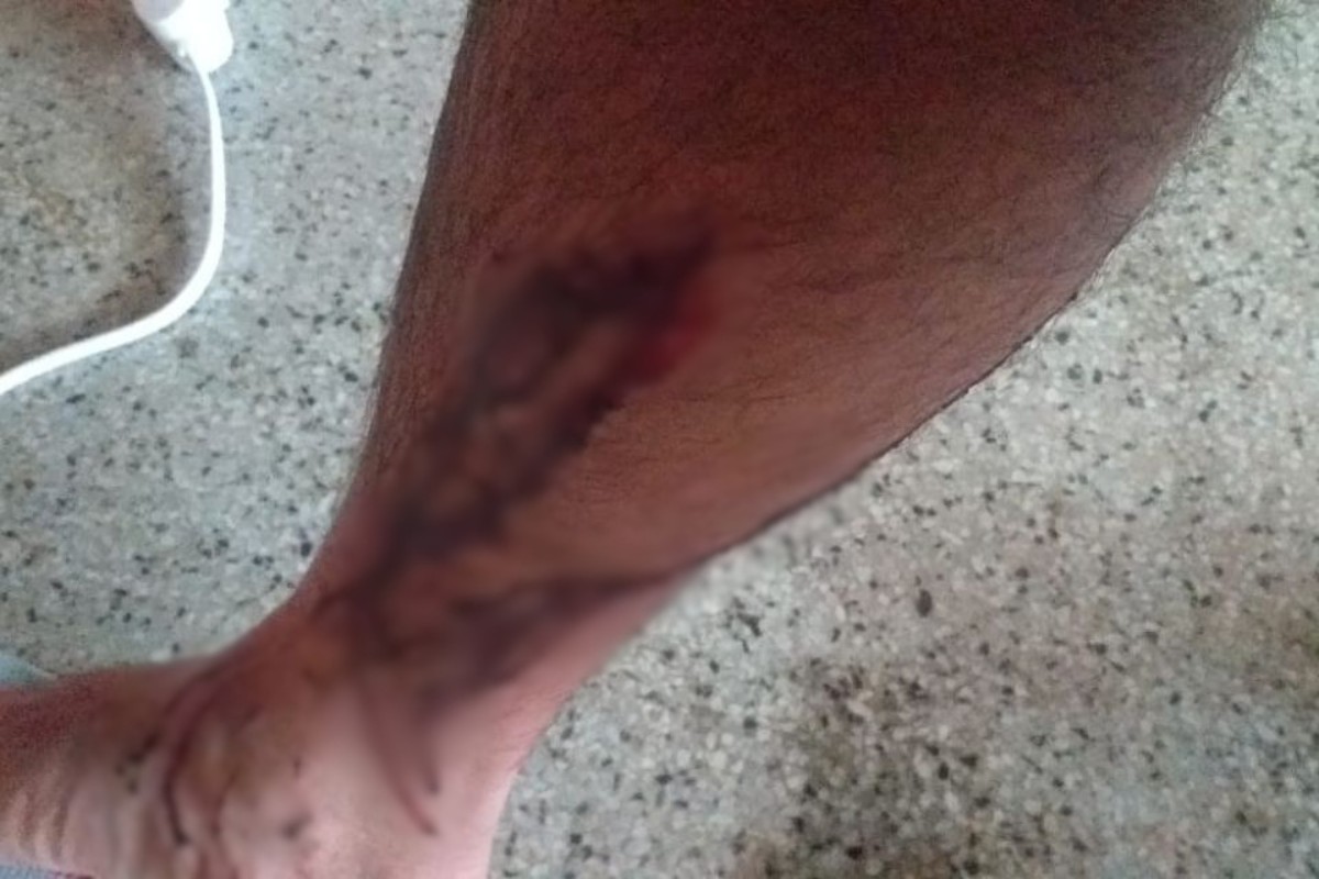 UFRPE é condenada a pagar R$ 10 mil a estudante atacado por cães dentro de campus em Serra Talhada