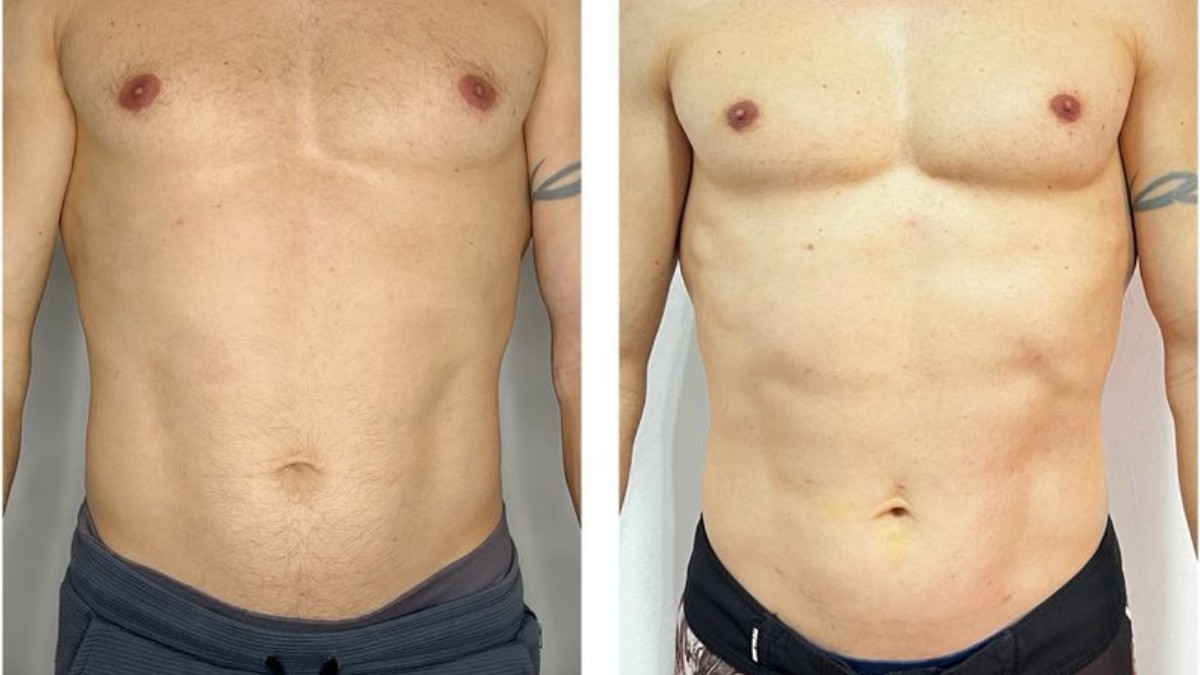 
Técnica inovadora de lipo sem cirurgia é lançada por grupo catarinense