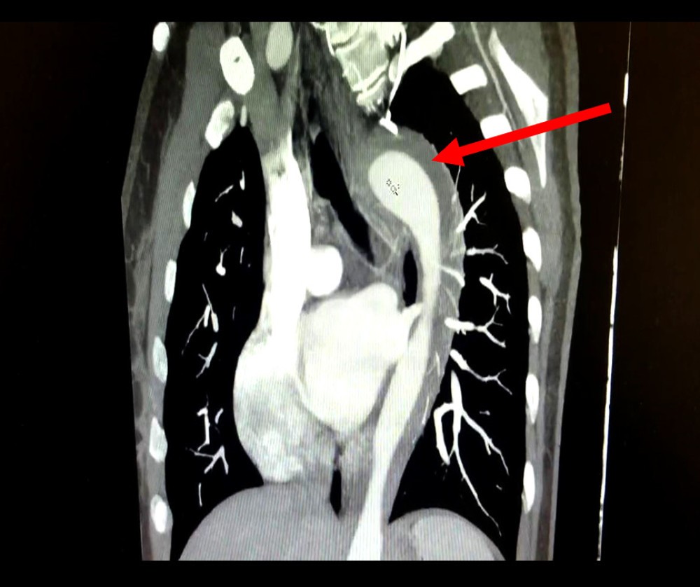 Em caso raro, mulher de 45 anos rompe aorta após orgasmo; entenda a condição