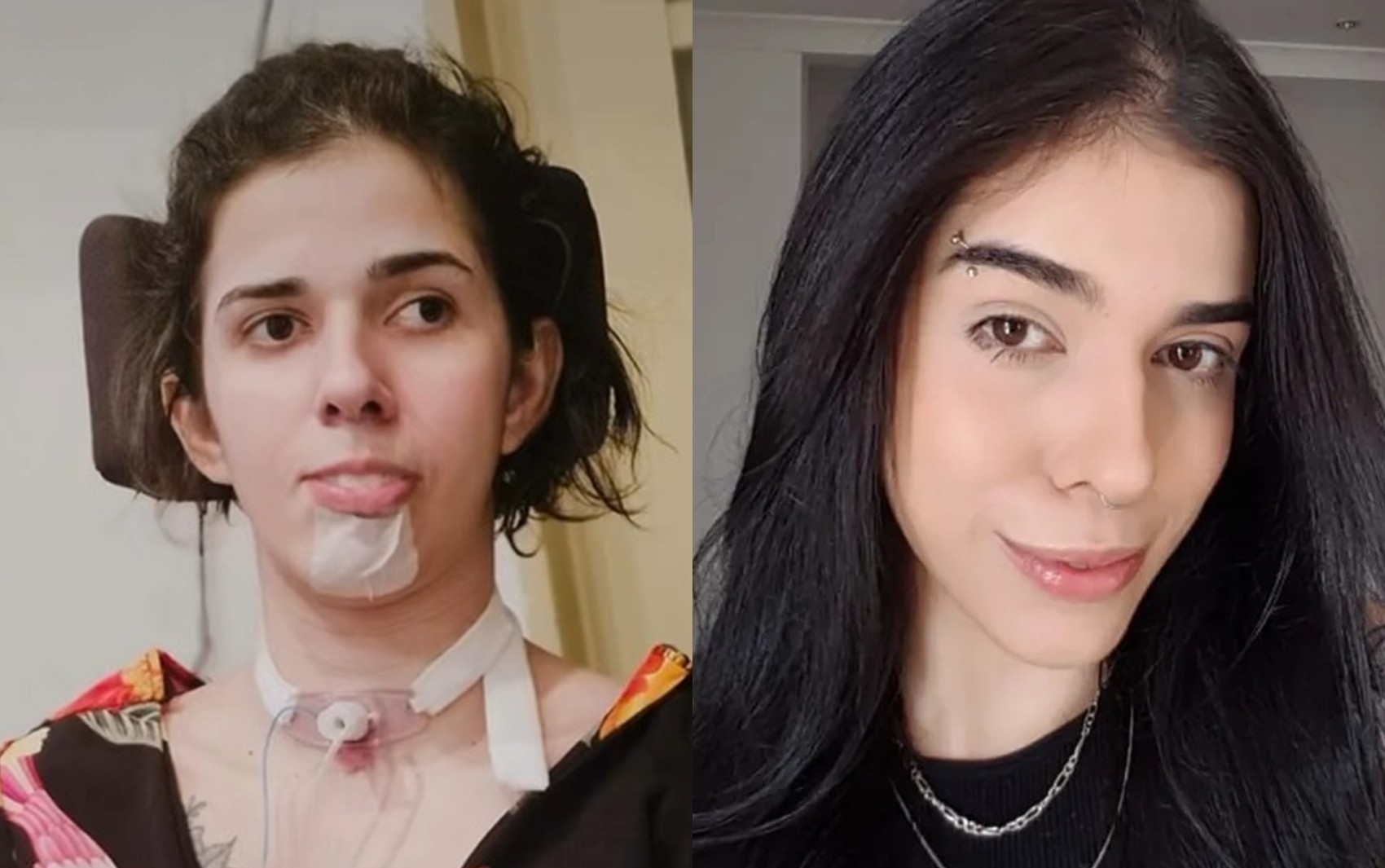 Mãe de jovem que teve graves sequelas ao cheirar pimenta desabafa três anos após reação alérgica da filha: 'Queria estar no seu lugar'