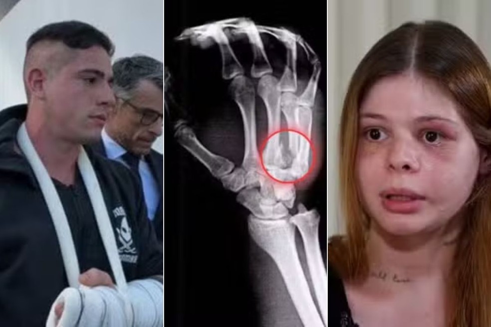 Pedro Camilo Garcia fraturou osso da mão ao espancar namorada Samira Mendes Khouri — Foto: Matheus Croce/TV Tribuna, g1 Santos e Reprodução/TV Globo