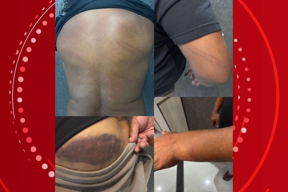 Perdigão publicou nas redes sociais fotos que mostram hematomas após abordagem policial — Foto: Redes sociais