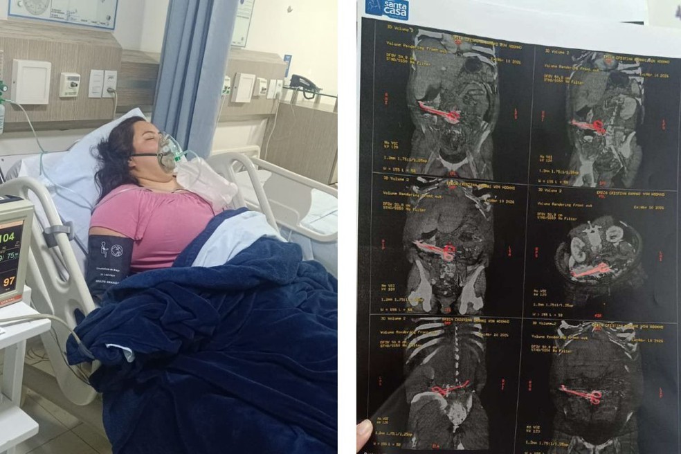 Erica em uma das hospitalizações e raio-X de pinça no abdômen. — Foto: Reprodução/Arquivo pessoal