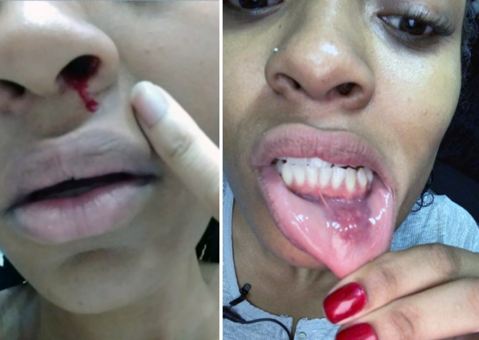 Patrícia Ramos mostra ferimentos — Foto: Reprodução/TV Globo