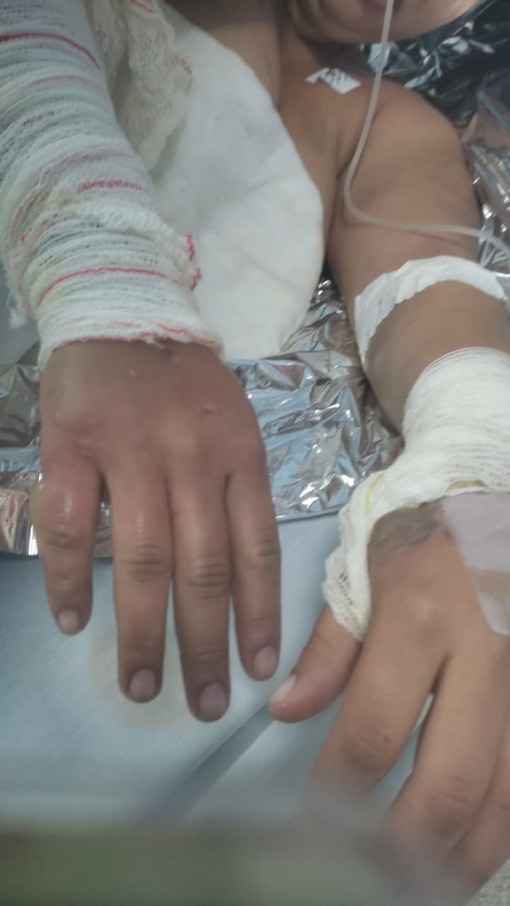 Suspeito de atear fogo na ex-namorada é preso em Sumaré; vítima continua internada