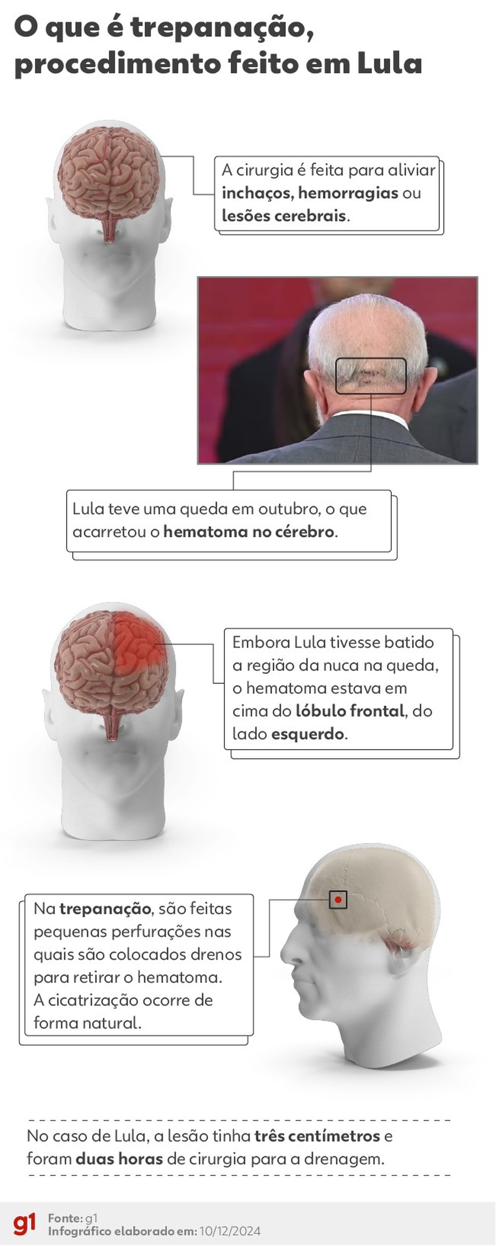 Trepanação: entenda procedimento feito em Lula — Foto: Arte/g1