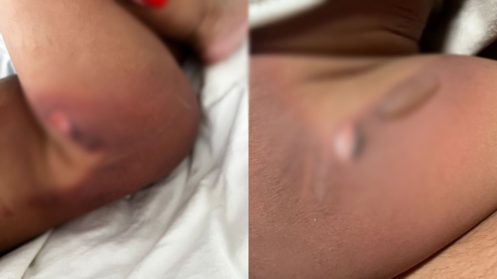 Bebê de 11 meses sofreu queimaduras durante banho em creche de Jaú — Foto: Arquivo Pessoal