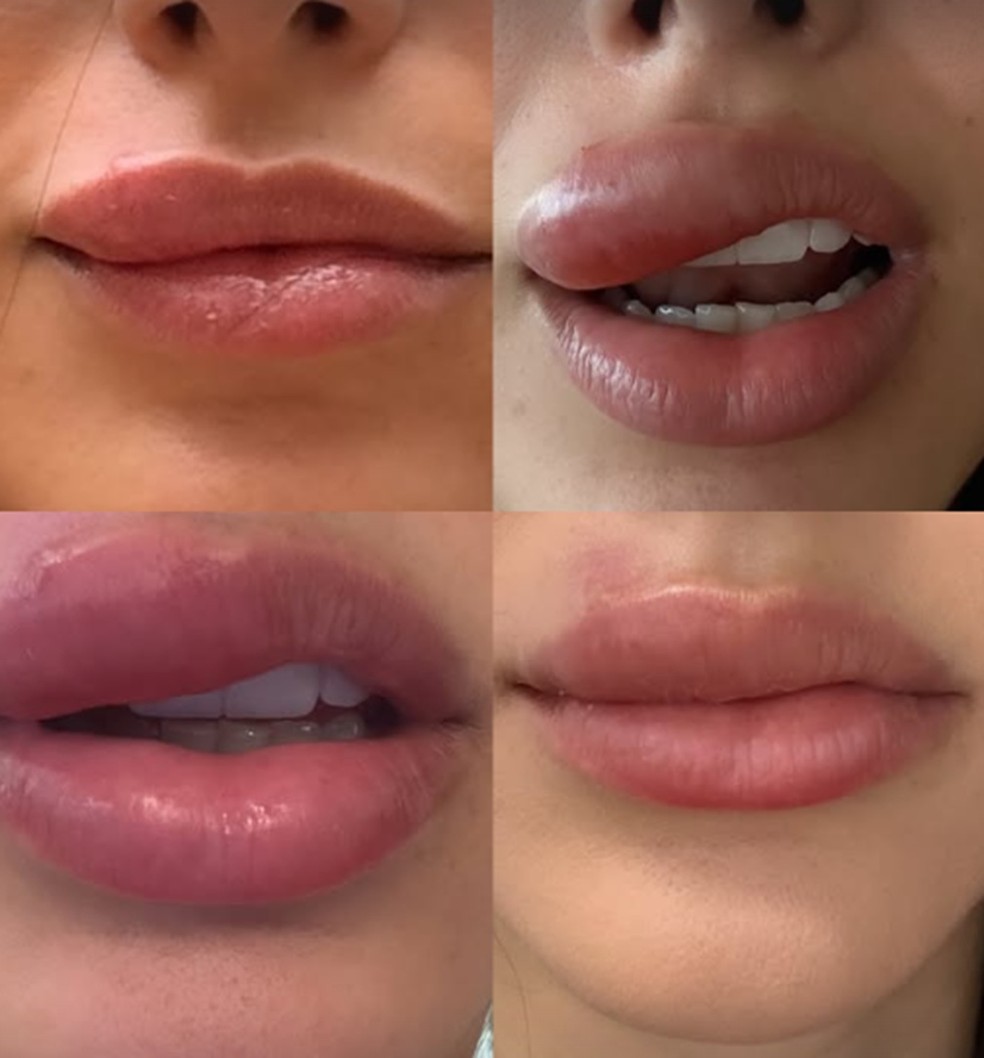 Bruna Biancardi teve celulite facial — Foto: Reprodução/Instagram