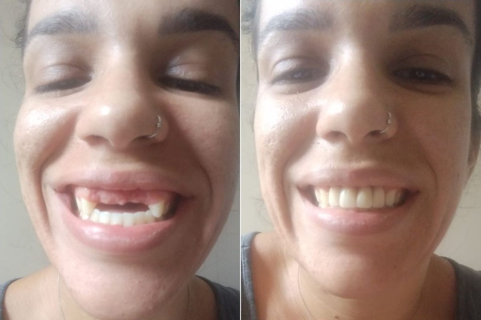 Atualmente, Aline Ferreira de Oliveira usa uma prótese temporária — Foto: Arquivo Pessoal