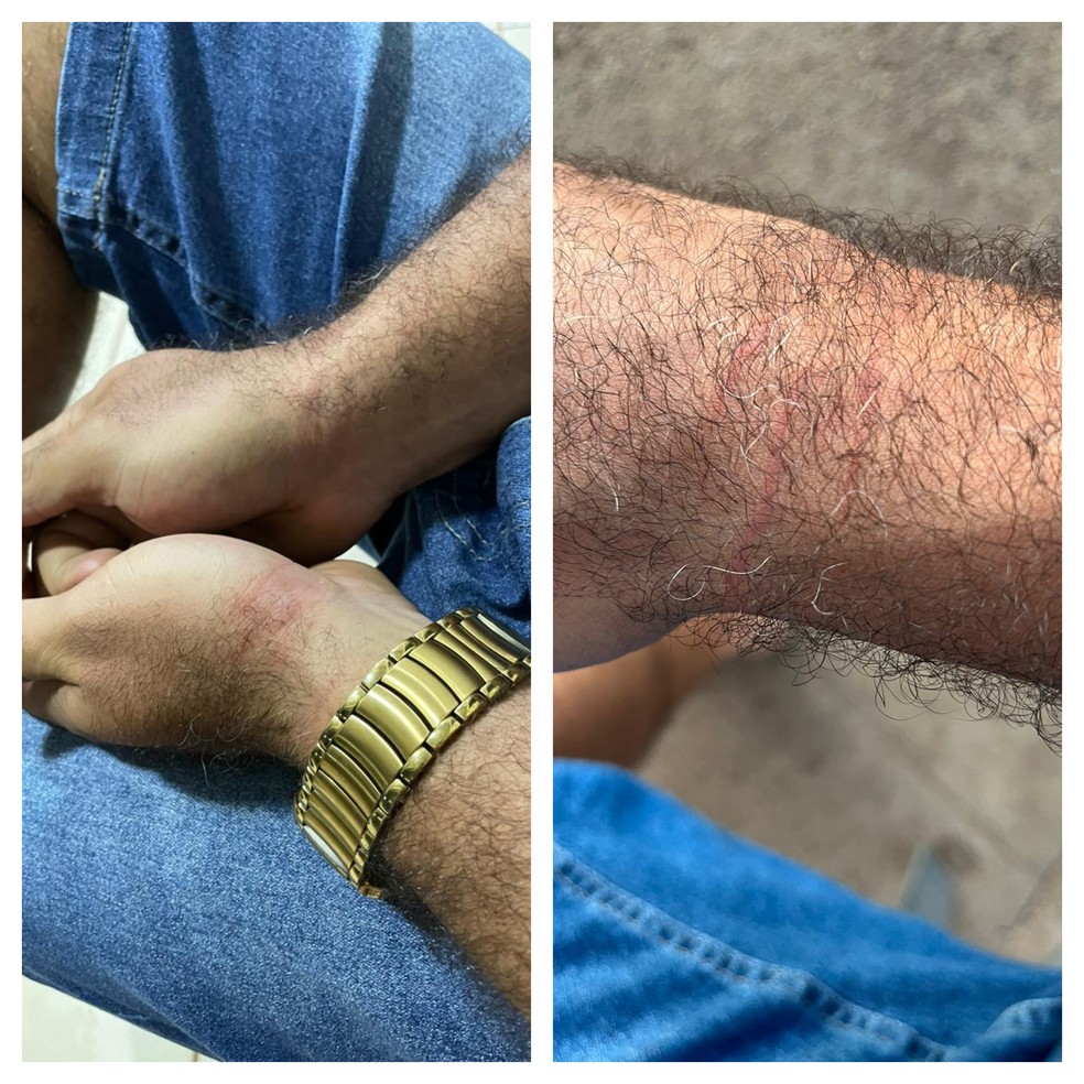 Durante a prisão, policiais machucaram Sandro ao tentar algemá-lo  — Foto: Arquivo pessoal 