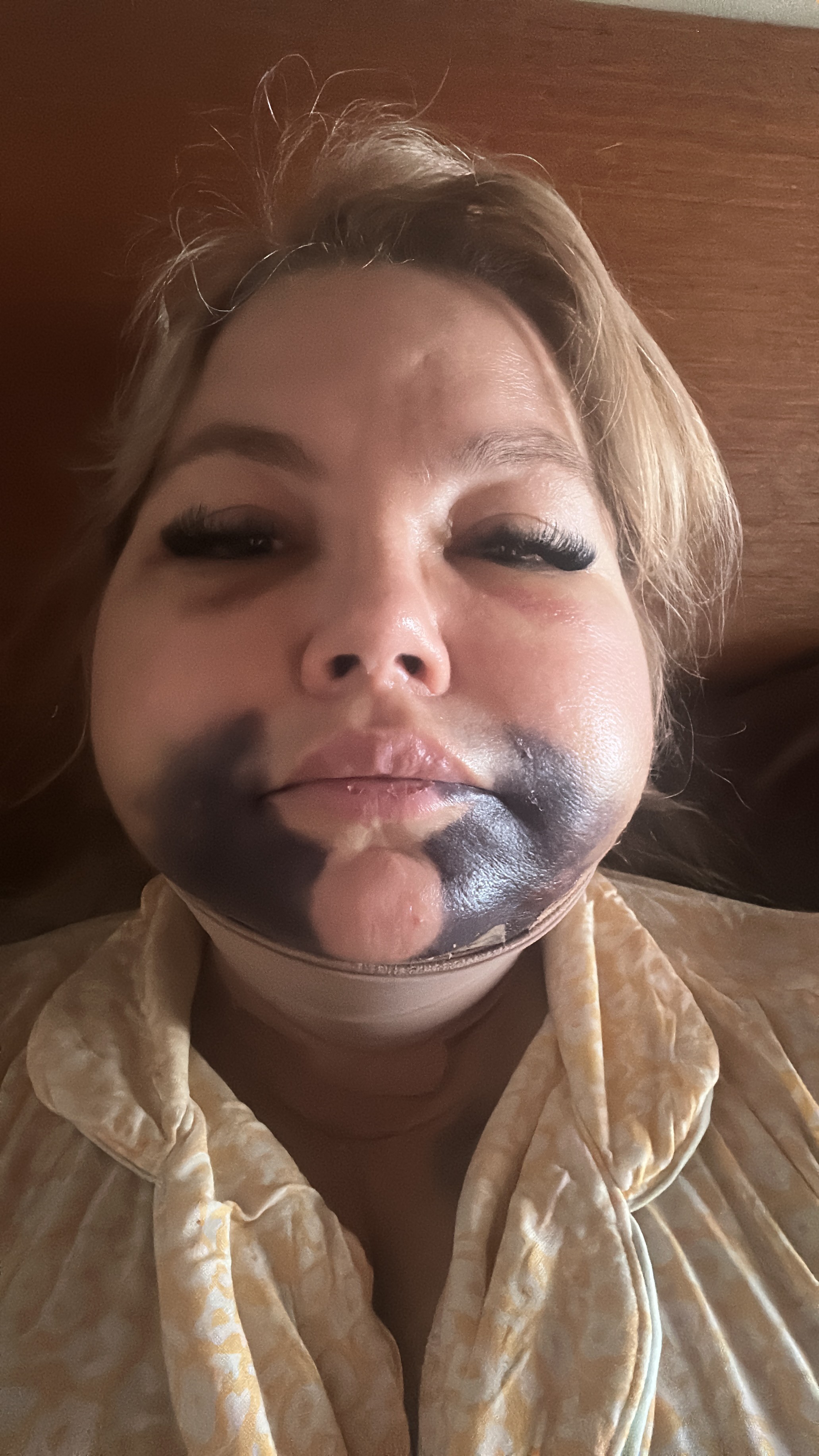 Advogada sofre deformações no rosto após procedimento estético; cirurgiã-dentista é ré por lesão corporal gravíssima 