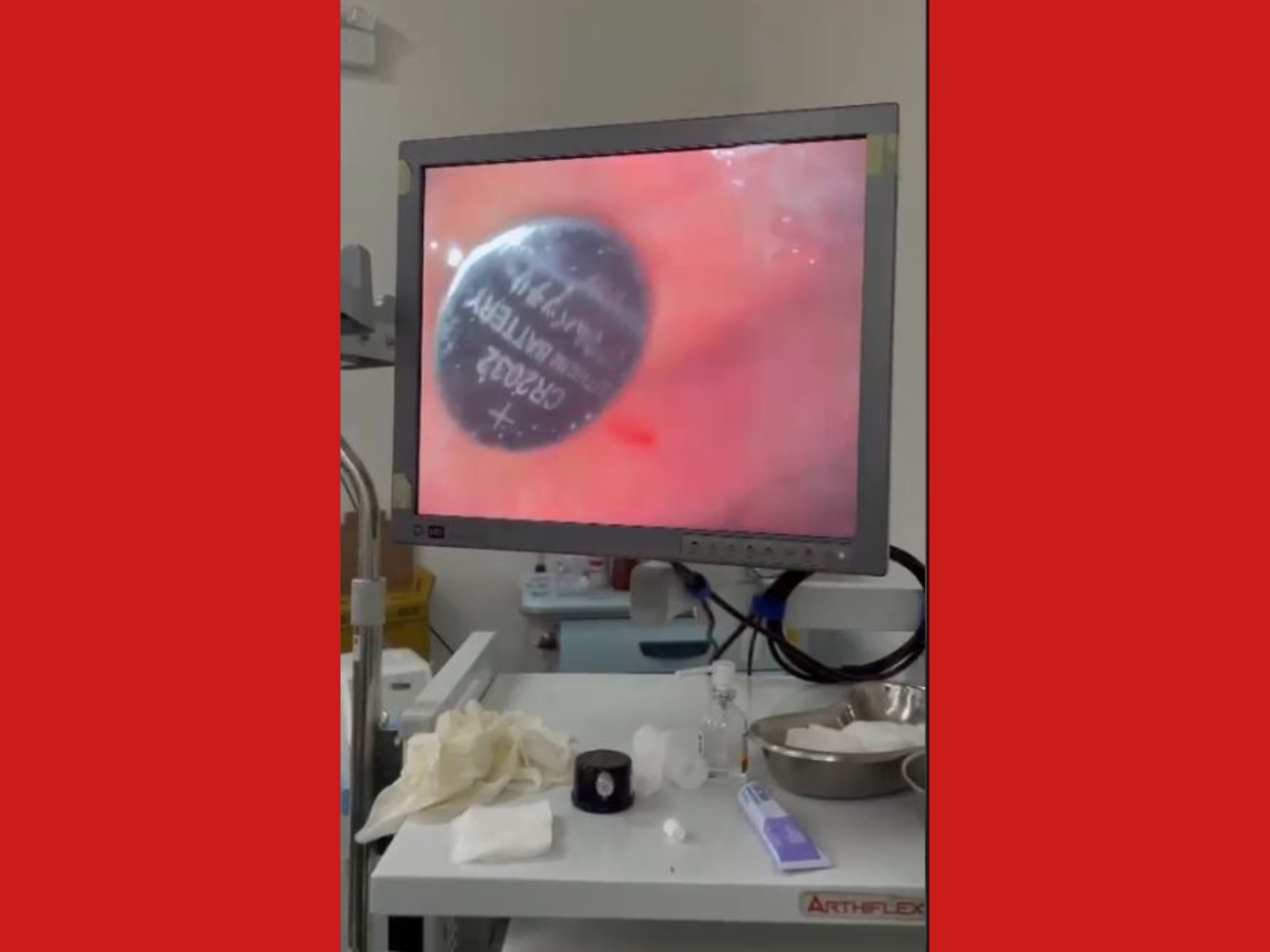 VÍDEO: Médicos retiram bateria de lítio do estômago de criança de 1 ano e 9 meses no Acre 