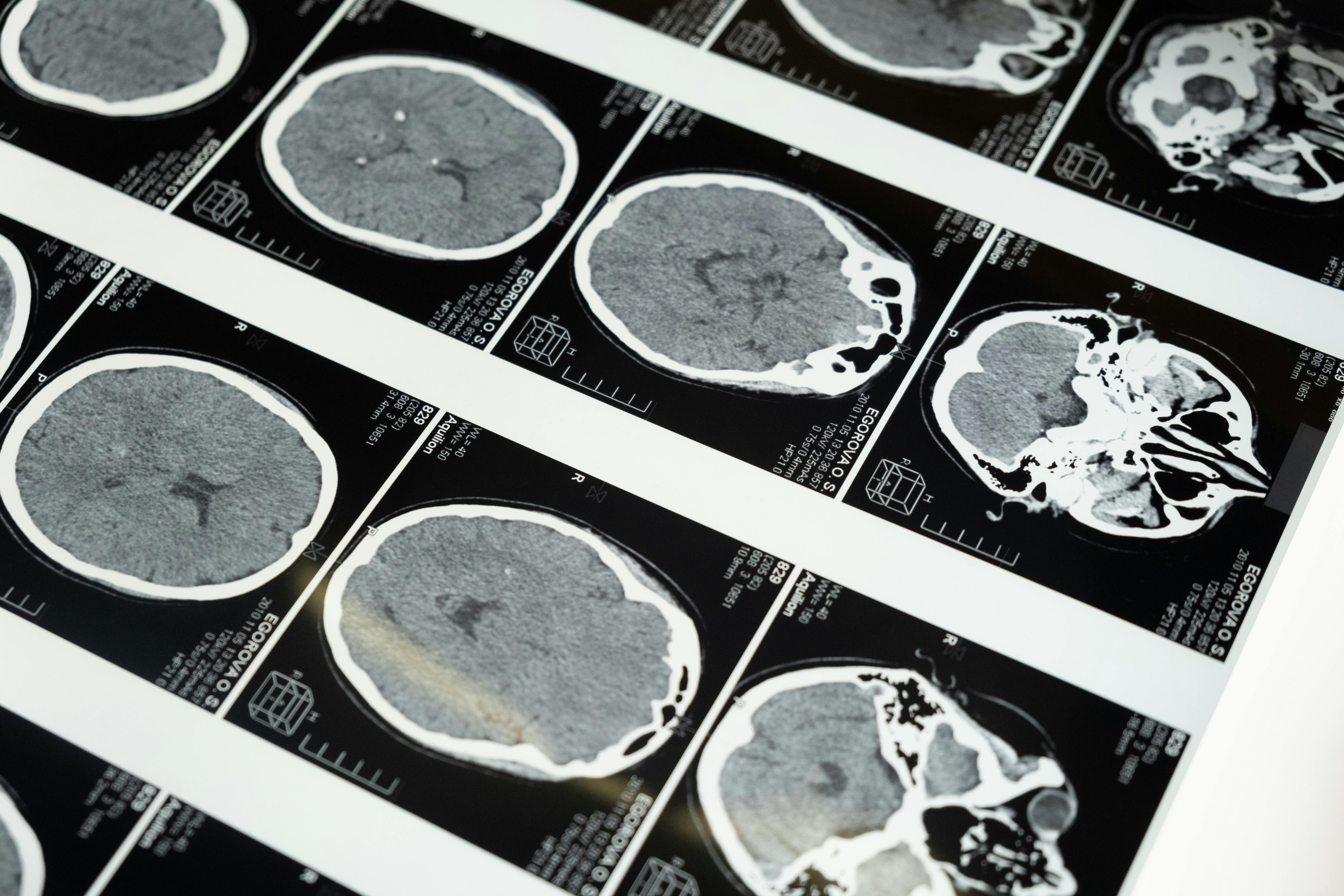 Doenças priônicas: os enigmas das proteínas que 'entortam' e destroem o cérebro