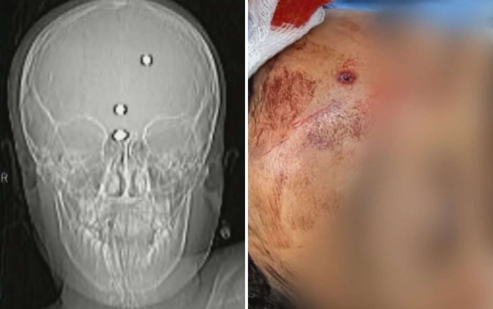 Menino baleado na cabeça sai da sedação, volta a falar e emociona a família; mãe e padrasto estão presos 