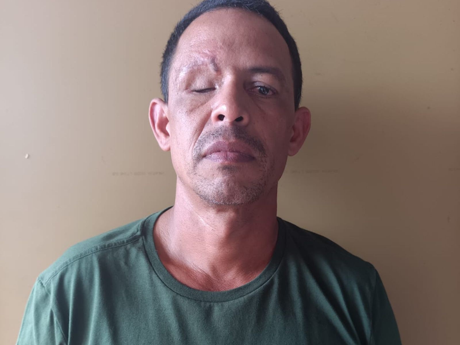 Policial do AC que perdeu olho ao levar tiro em rebelião segue em tratamento após 2 anos: 'Descaso'