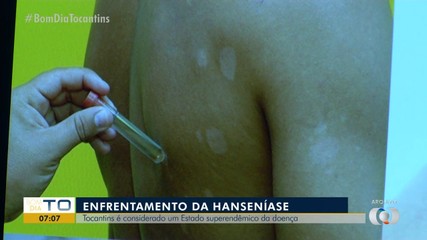 Tocantins é considerado um estado superendêmico em casos de hanseníase