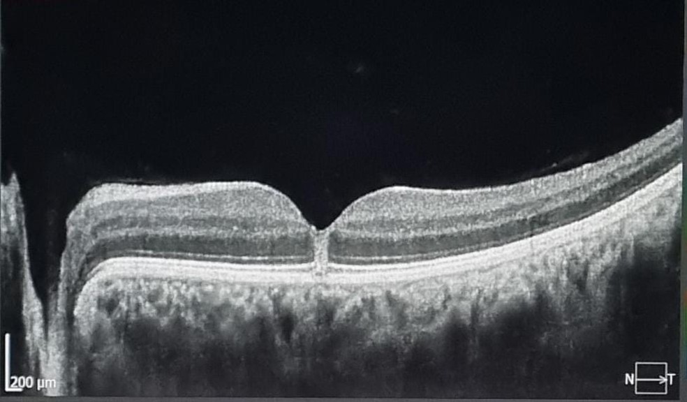 Lesão central na retina de um dos olhos da potiguar que olhou para o eclipse solar anular sem proteção. — Foto: Foto: Cedida