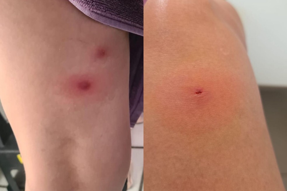 Fotos mostram estágio inicial das picadas por aranha-marrom em dentista — Foto: Arquivo pessoal