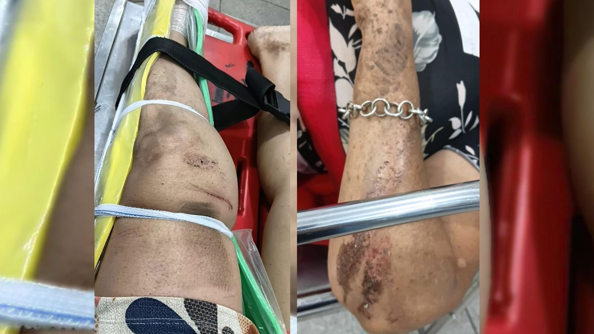 Suspeito de quebrar dentes de médica e atropelar mulher de 62 anos tem prisão decretada no interior de SP