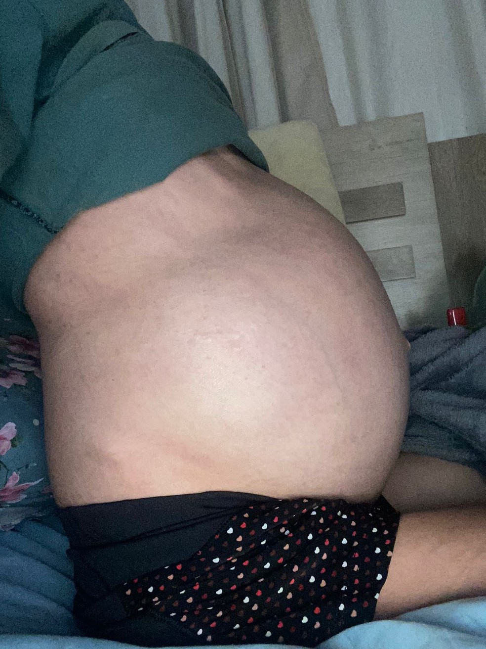 Durante o tratamento, Linda desenvolveu Ascite, mais conhecida como 'barriga d'água' — Foto: Reprodução