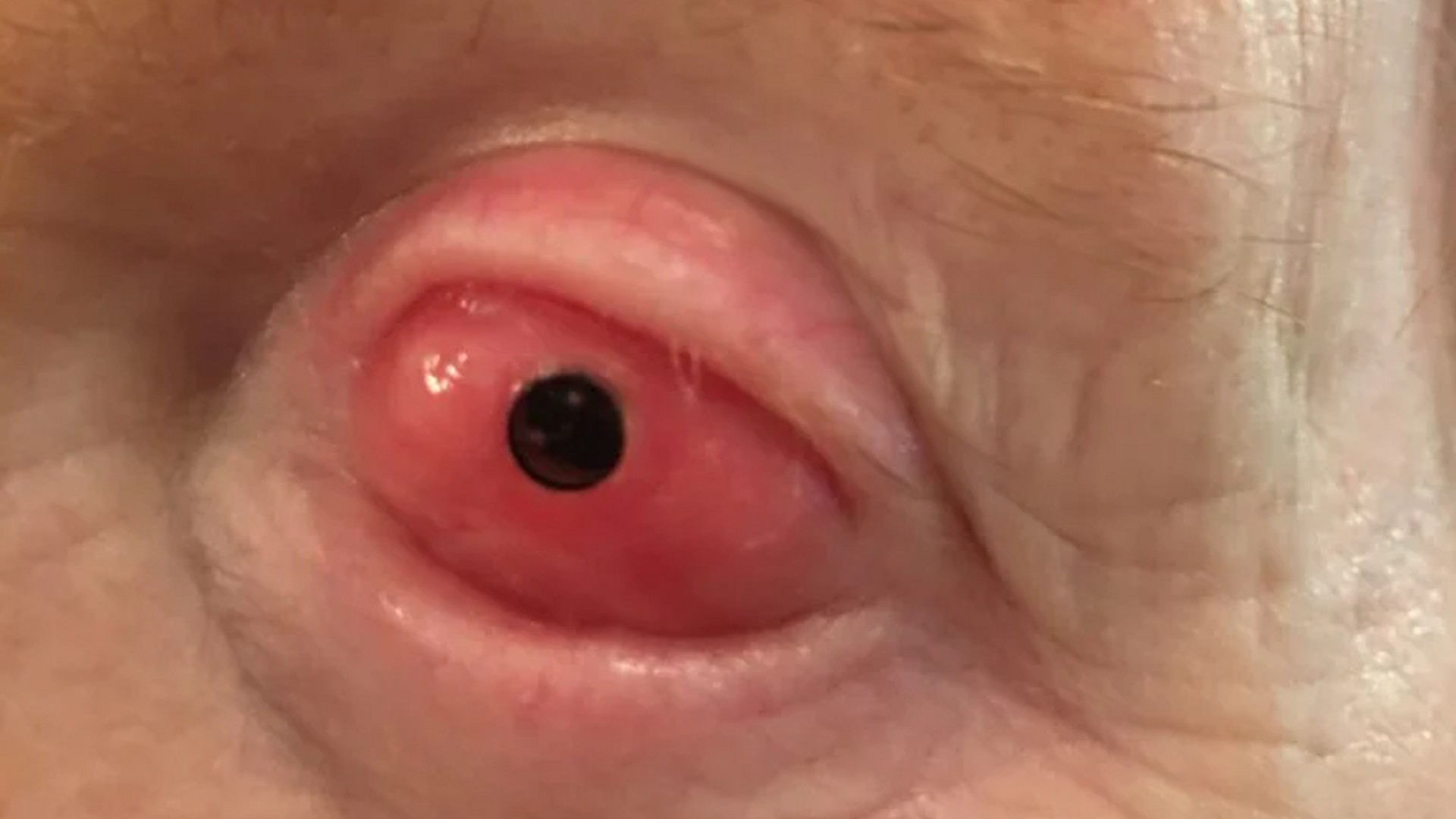 Dente-no-olho: entenda cirurgia que faz pessoas cegas recuperarem a visão |  G1