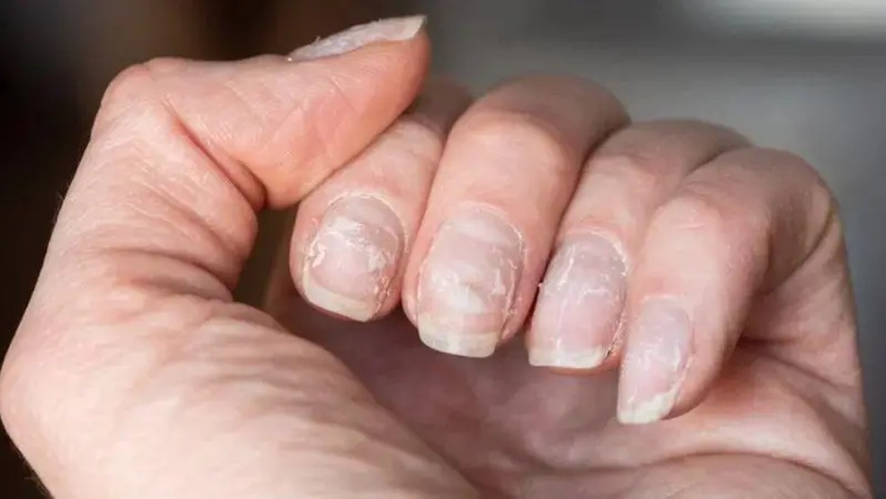 As unhas podem apontar diversos problemas de saúde — Foto: Getty Images via BBC