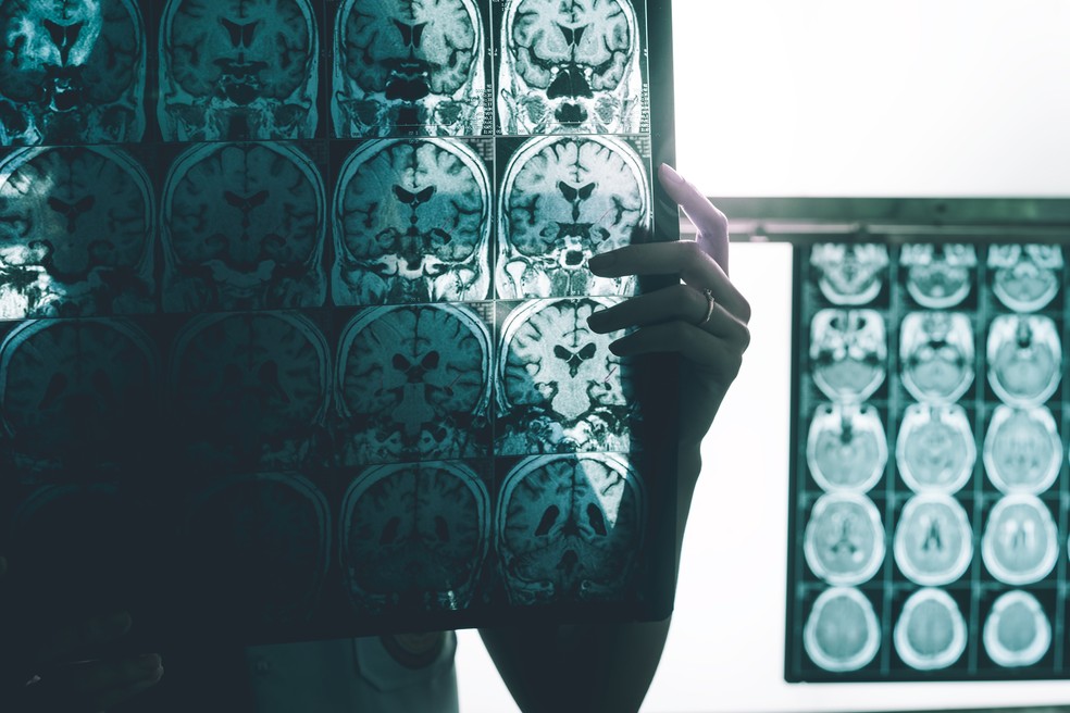 BRASIL: Cientistas descobrem como “reprogramar” células de defesa do cérebro para combater o Alzheimer