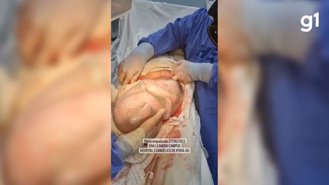 VDEO: Mulher d  luz a gmeas e uma das bebs nasce empelicada