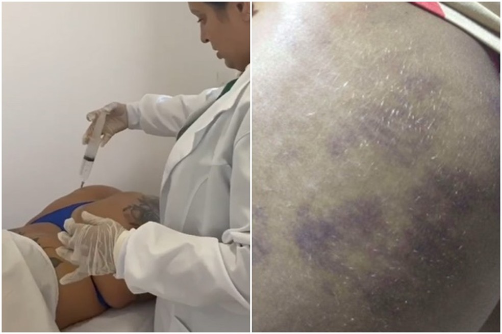 Suspeita teria utilizado silicone de construção em pacientes que teve complicações — Foto: Reprodução/TV Cabo Branco