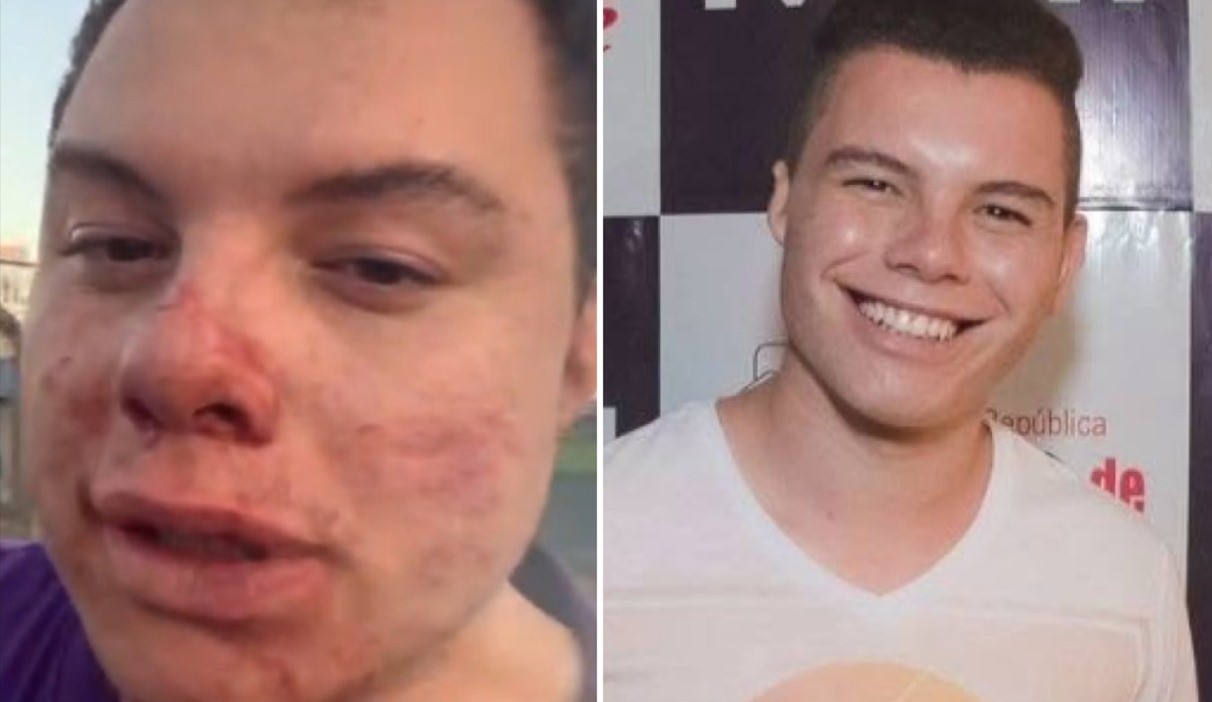 O que se sabe sobre influenciador em coma após agressão em festa universitária no interior de SP