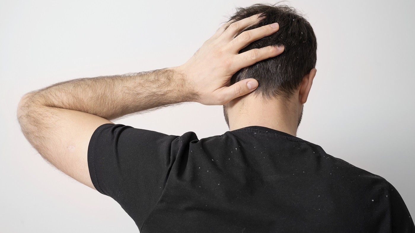 Caspa tem solução? Entenda como hábitos corretos ajudam a manter o couro cabeludo em equilíbrio