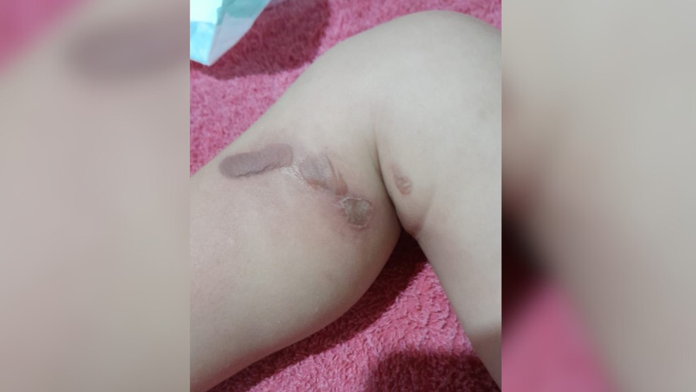 Polícia investiga queimaduras em perna de bebê durante banho em creche em Votuporanga (SP) — Foto: Arquivo pessoal