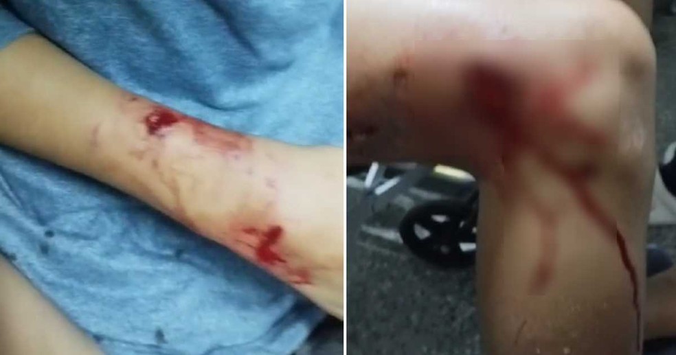 Pedro Lucas teve ferimentos profundos na perna direita após ser atacado por pitbull — Foto: Reprodução
